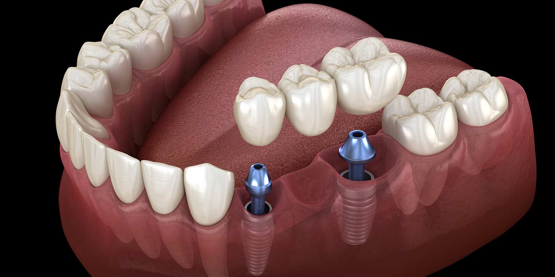 How do you care for dental implants?